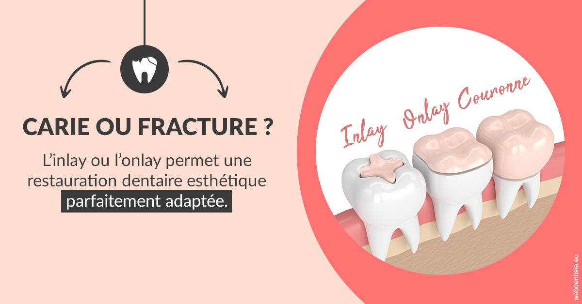 https://dr-landreau-franck.chirurgiens-dentistes.fr/T2 2023 - Carie ou fracture 2