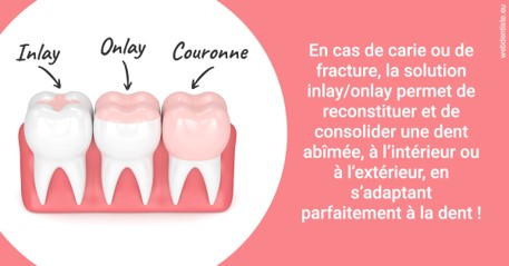 https://dr-landreau-franck.chirurgiens-dentistes.fr/L'INLAY ou l'ONLAY 2